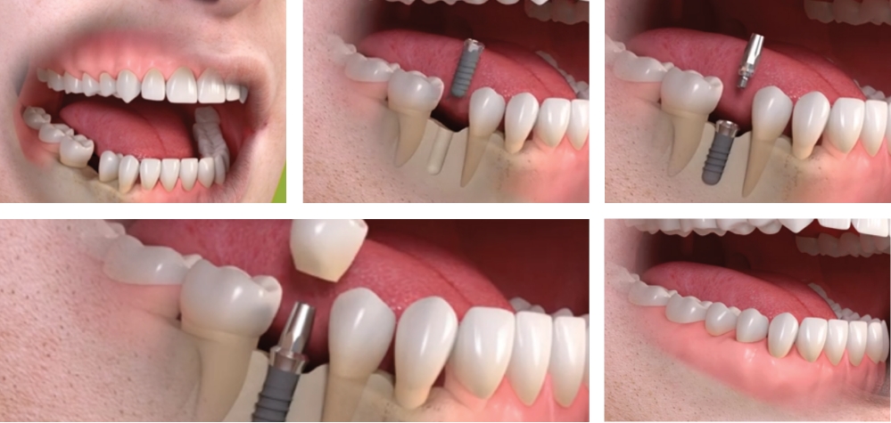 Single tooth implant